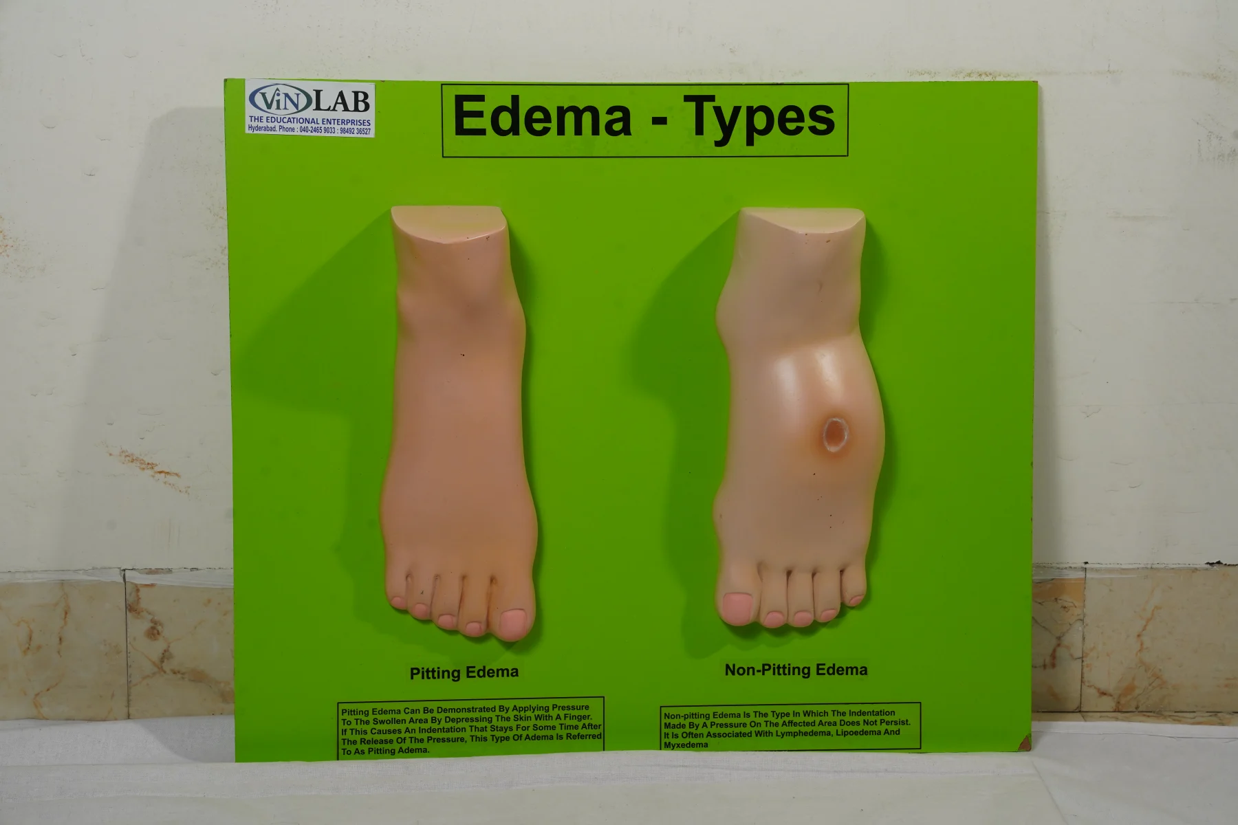 Edema Types thumbnail 2