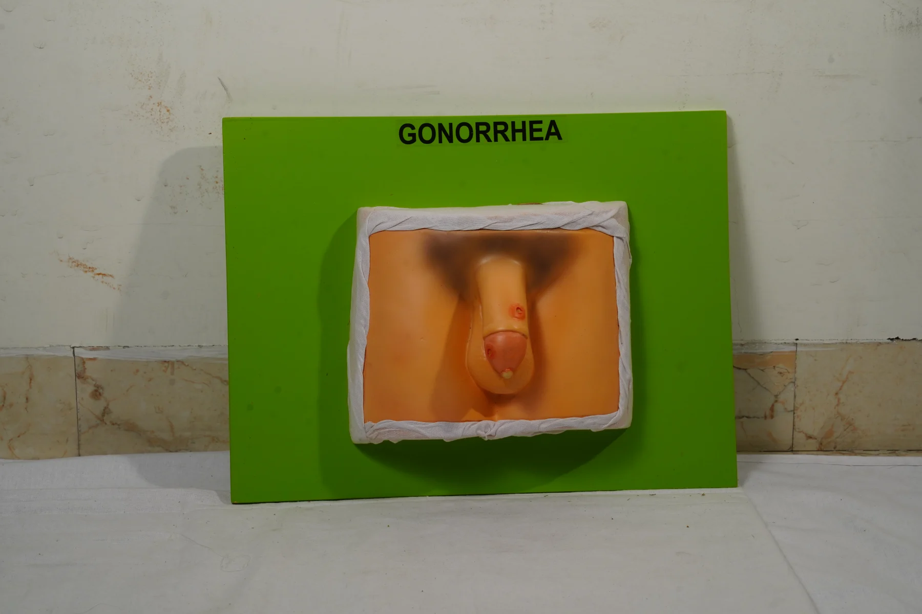Gonorrhea thumbnail 3